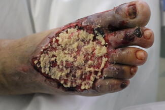 Application of porcine-derived extracellular matrix powder.