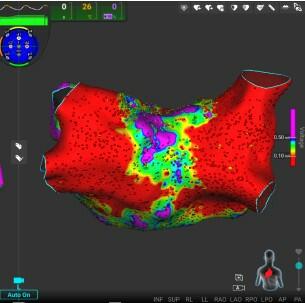3D map of incomplete PLA ablation for EPLD Knight