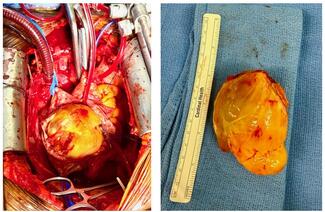 Figure 2. Myxoma en situ.