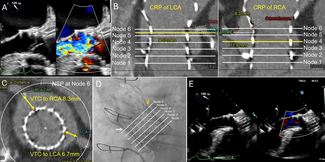 Lerakis Figure. Transesophageal echocardiography of flail left coronary cusp