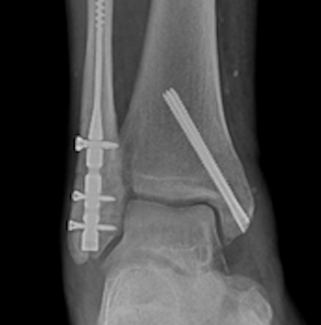 When to Fix, and When Not to Fix, Ankle Fractures: Evidence-Based Decision Making for the Foot and Ankle Surgeon