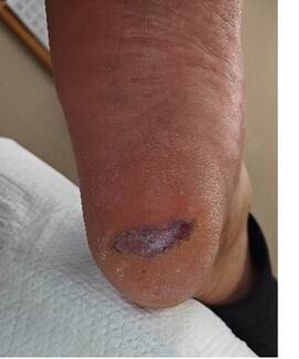 Initial presentation of a heel lesion in a 44-year-old male.