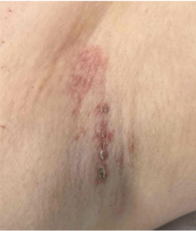 Hyperkeratotic, eroded erythematous plaque