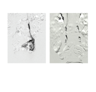CLD Winokur Figure 1 pre and post pelvic vein embolization