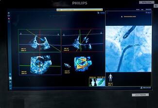 Philips DeviceGuide with EchoNavigator 5 Screen