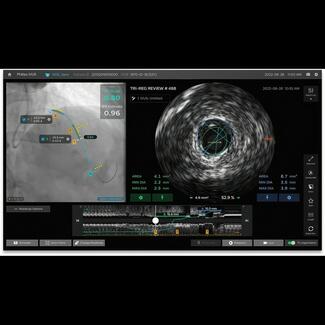 Philips IntraSight Plus Screen Image