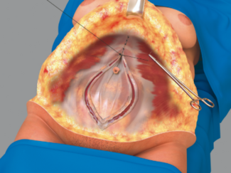 Artistic view of the creation of the new linea alba.