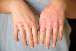 hand eczema