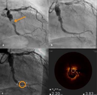 Anwari Figure_serial imaging of the culprit imaging