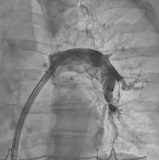 Figure 1. Baseline pulmonary angiography demonstrated a large thrombus in the left pulmonary artery.