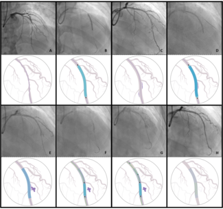 Figure 1_basal angiogram
