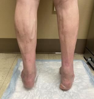 Figure 4. Clinical image in stance showing a mild varus position on the right.