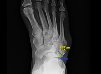 Symptomatic Os Cuboideum Secundarium in a High-Risk Foot: A Rare Anatomical Variant with Clinical Consequences