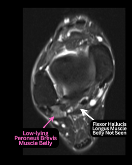 Peroneal tendinosis with surrounding fluid, suspicious for possible peroneal tendon pathology