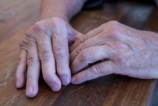 Psoriatic Arthritis+Hands