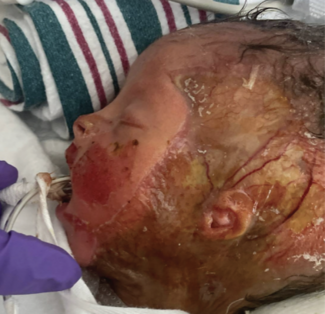 aplasia cutis congenita