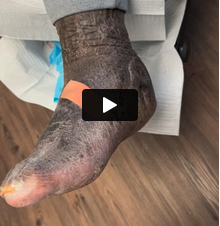 Advances in Charcot Neuroarthropathy Surgical Techniques Video