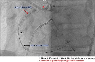 modified_TILT_ping_ping_guides