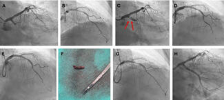 Theo Figure_coronary angiogram