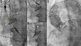 Chimney stenting during transcatheter ViV aortic valve implantation