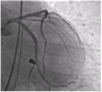 CLD Brown Final Angiogram