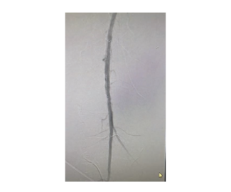 Figure 3. A post-intervention left-sided angiogram showing excellent results with TIMI-3 flow. 