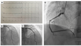 Malhi Figure 1_baseline normal ECG
