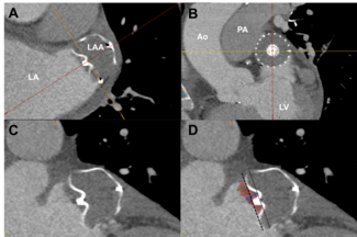 Feroze Figure 1. Cardiac CT measurements