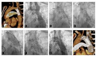 Anderson Figure_CT_coarctation