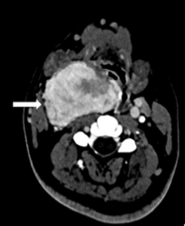 Figure 1A. Axial contrast-enhanced computed tomography shows an intensely enhancing mass (arrow) at the right carotid bifurcation. 