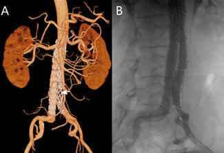 complete occlusion of the left iliac limb