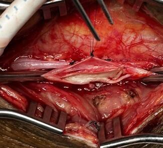 Figure 1A. Common ostium between tibial vein and artery