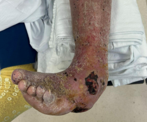 Extreme Limb Salvage in a High-Risk Patient With Chronic Foot and Ankle Deformity