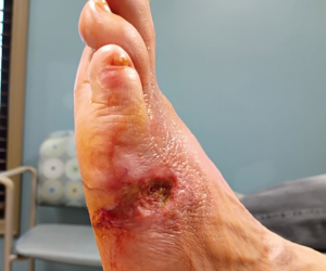 A Practical Alternative to NPWT in Rural Limb Preservation: A Case Report