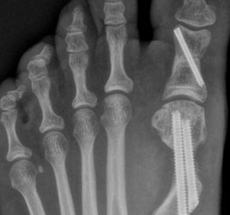 Case 1 radiographs of minimally invasive bunion correction. 