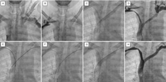 Singh Figure 1_venogram of left brachiocephalic vein
