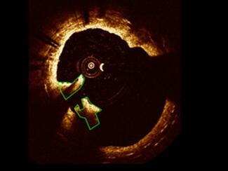 Example of clot quantification using OCT. Frame showing thrombi traced in green. 