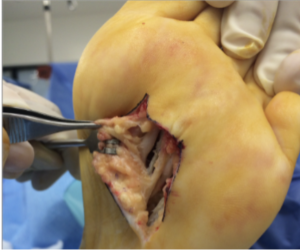 neuroma