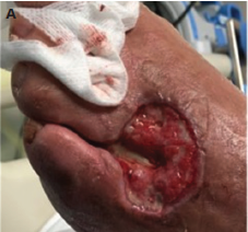 foot wound