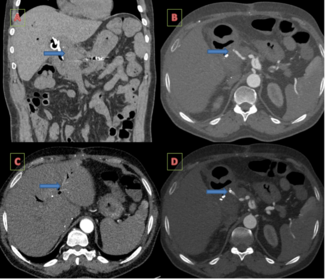 Figure 6. Follow-up CECT of the abdomen after 6 months showing contrast opacification within the transplant hepatic artery, intrahepatic part, and across the stent. 