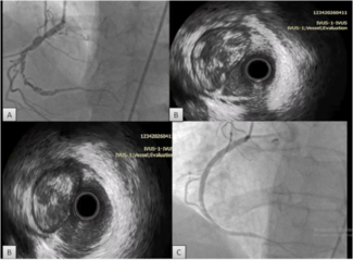 Kodal_Figure_IVUS