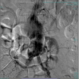 Final angiographic result showing correct stent graft positioning without evidence of endoleak.