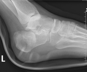 Percutaneous Management of Calcaneal Fractures: Evolution, Indications, and Surgical Pearls