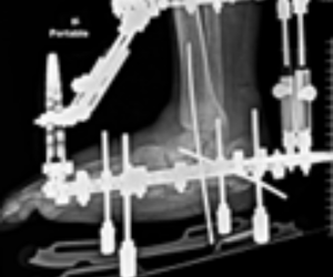 Should We Really Be Taking an “Ex-Fix Holiday” in Charcot Reconstruction? 