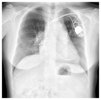 Pacemaker in patient