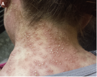 pustules