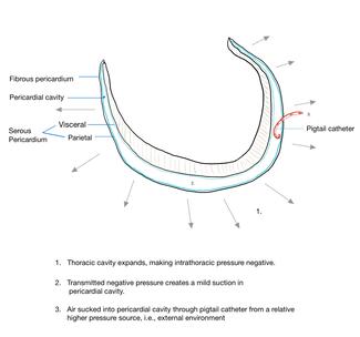 Pneumopericardium