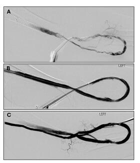 CLD Etkin et al Figure 4, Case #2.