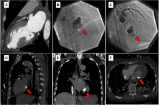 Fabris_Figure.left ventricular aneurysm