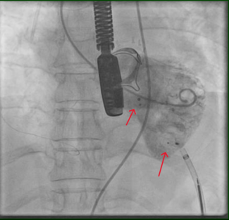 Lone_Figure 3_Postdeployment angiographic result